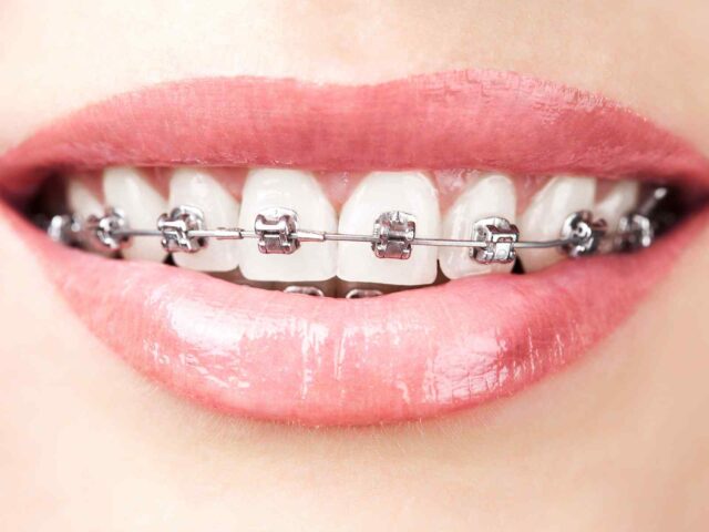 https://dianelladental.com.au/wp-content/uploads/2020/01/post_05-640x480.jpg