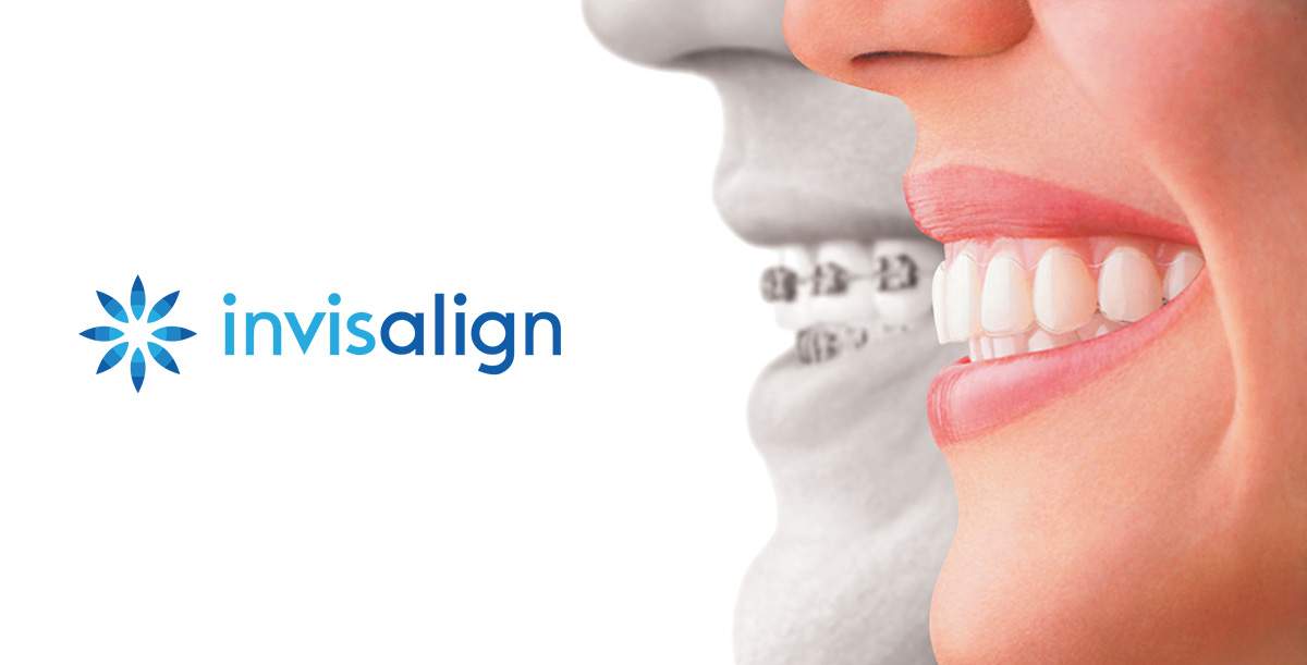 Invisalign Hacks