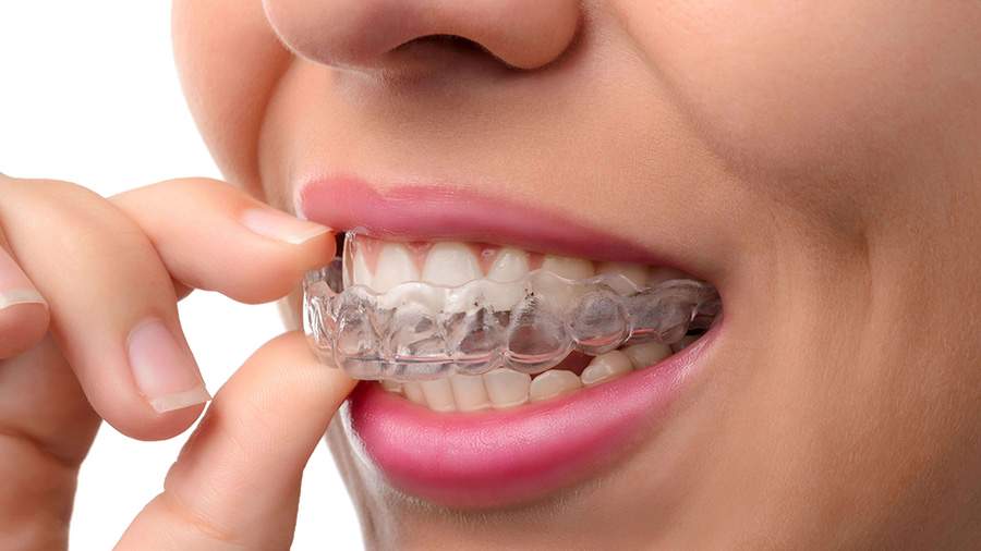 Invisalign Braces