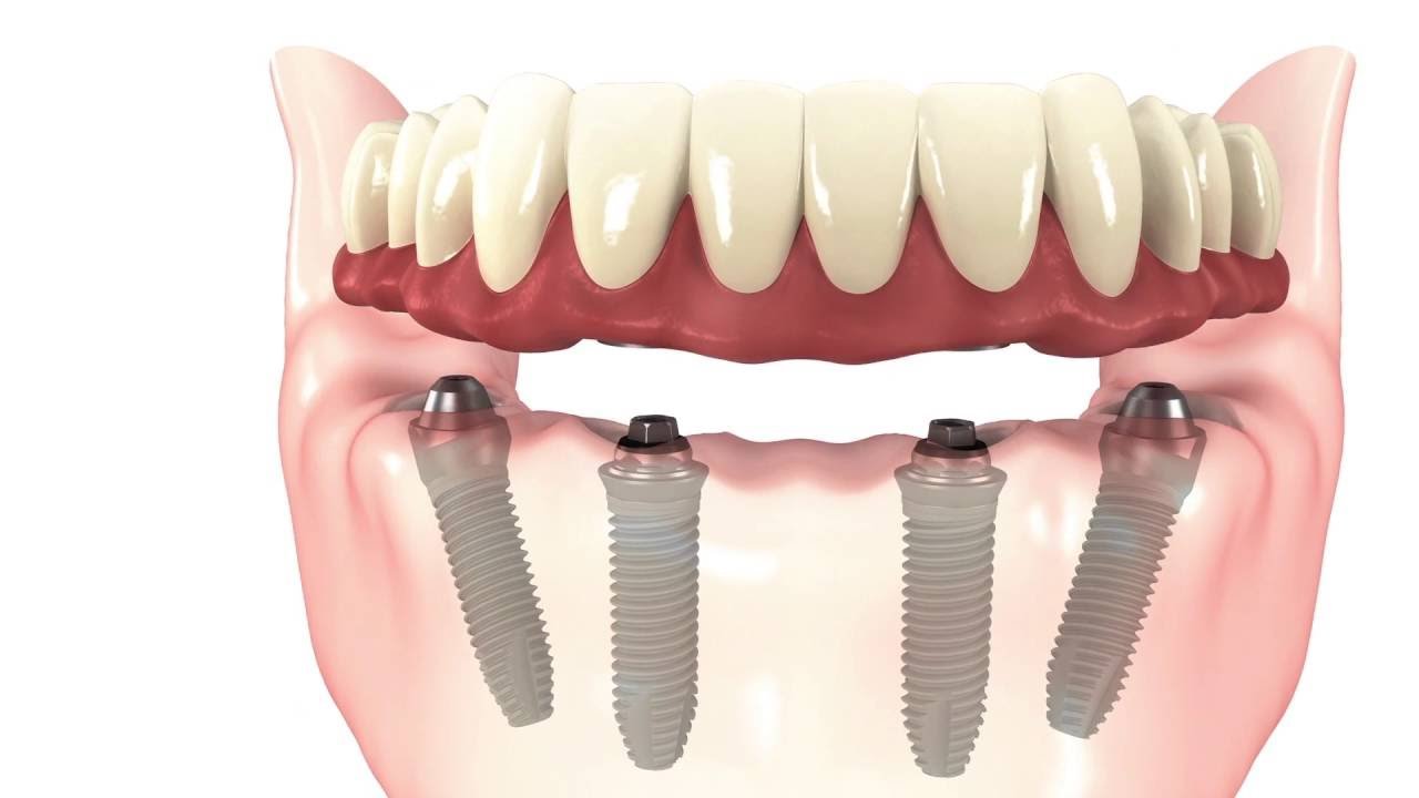 https://dianelladental.com.au/wp-content/uploads/2024/01/image3.jpeg