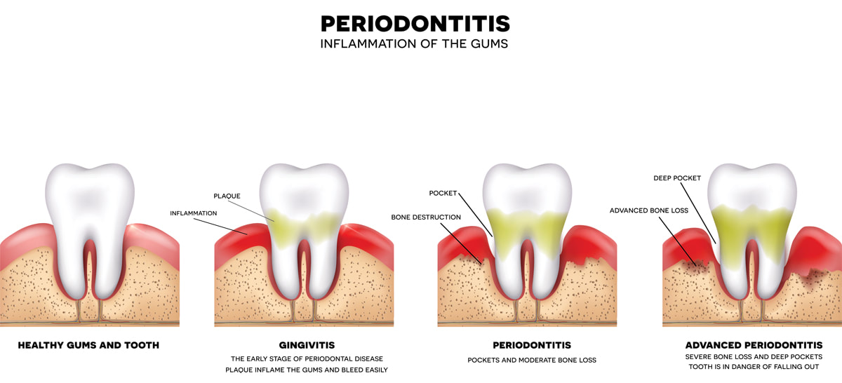 Understanding the Different Stages of Gum Disease and How to Prevent Them