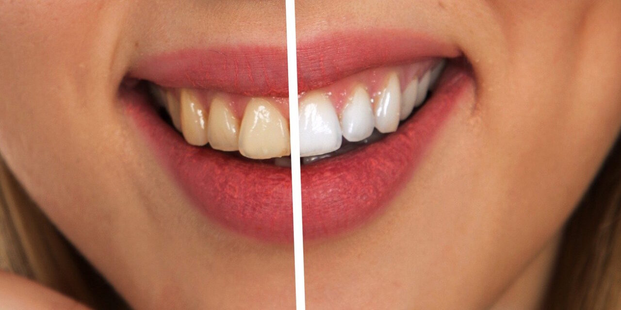 The Benefits of Professional Teeth Whitening vs. At-Home Whitening Kit